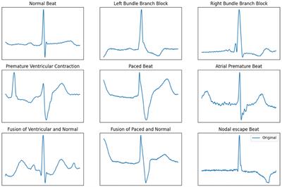 Real-time arrhythmia detection using convolutional neural networks